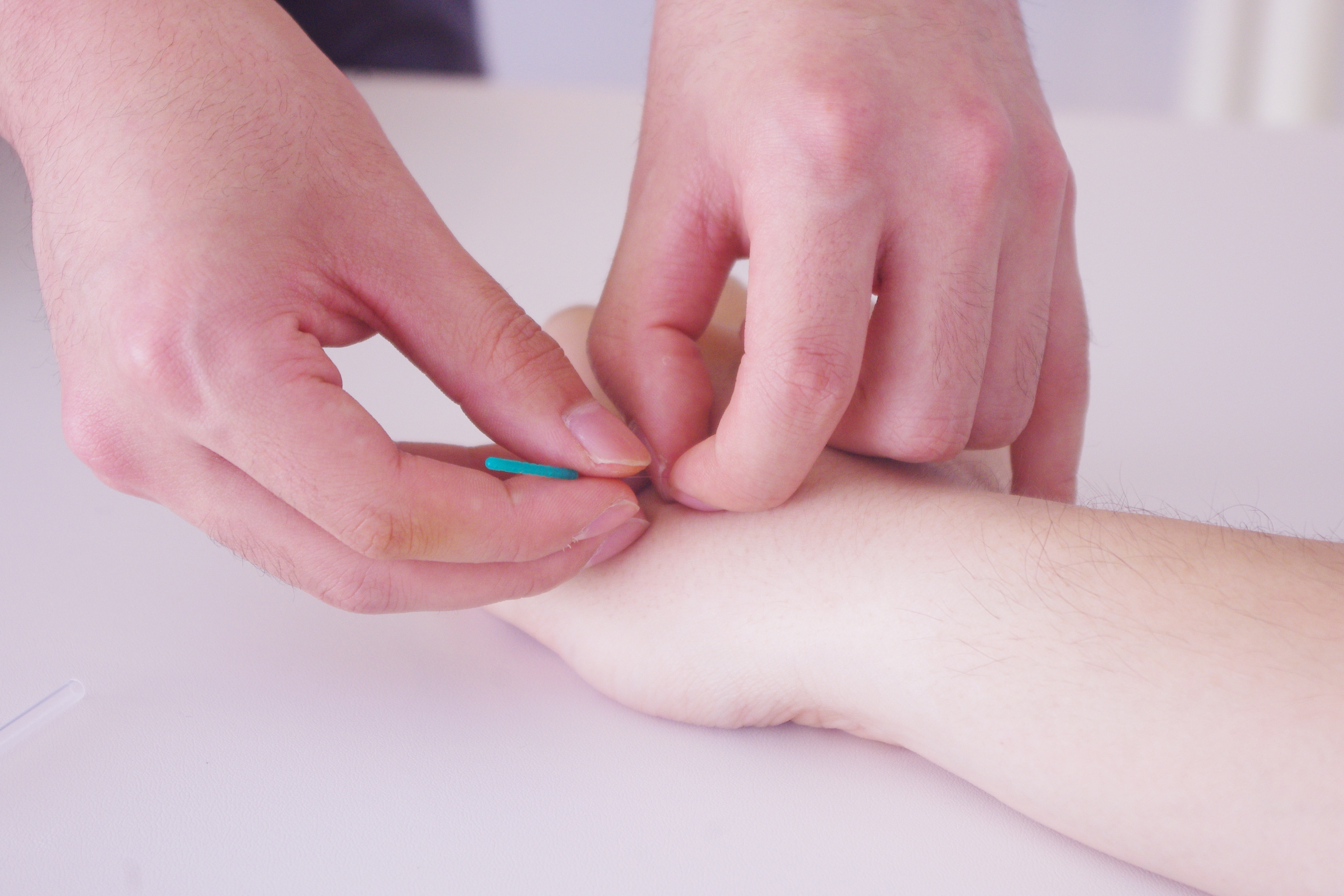 Cara mengecilkan tangan dengan akupuntur